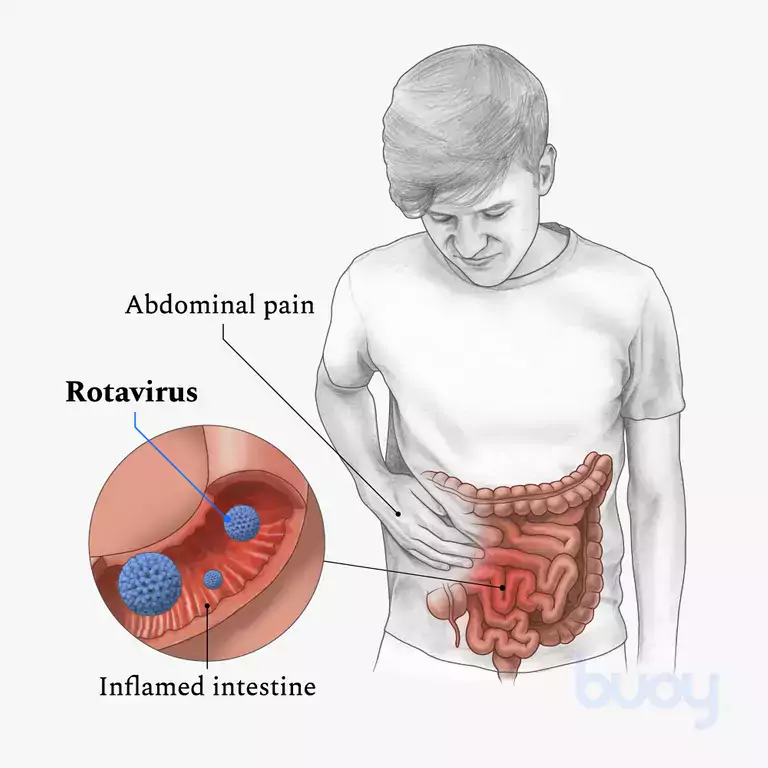 Infeksi Rotavirus