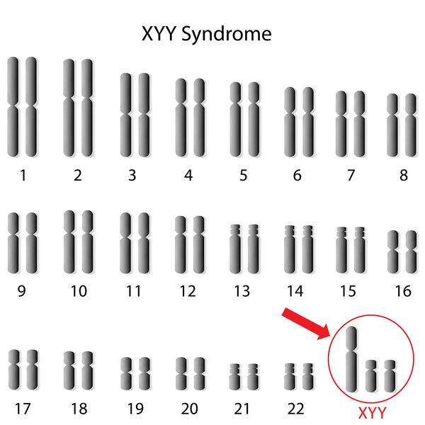 Sindroma XYY 