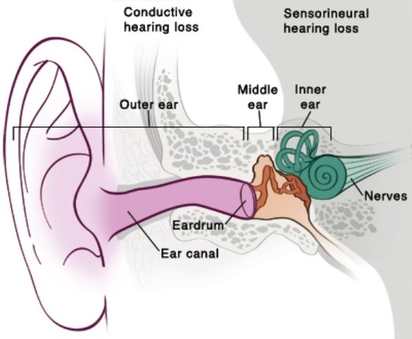 Gangguan Pendengaran pada Anak