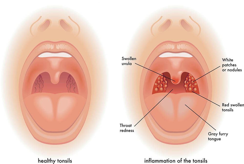 Tonsilitis (Radang Amandel)
