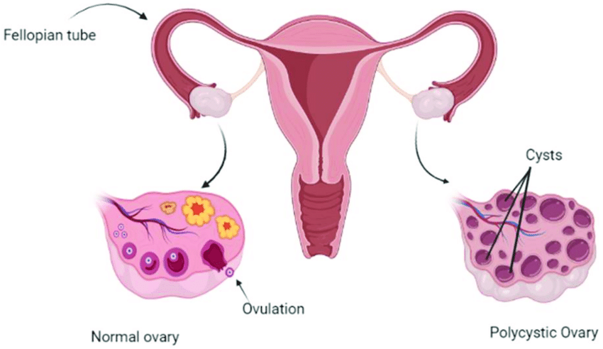 Sindroma Ovarium Polikistik (PCOS)