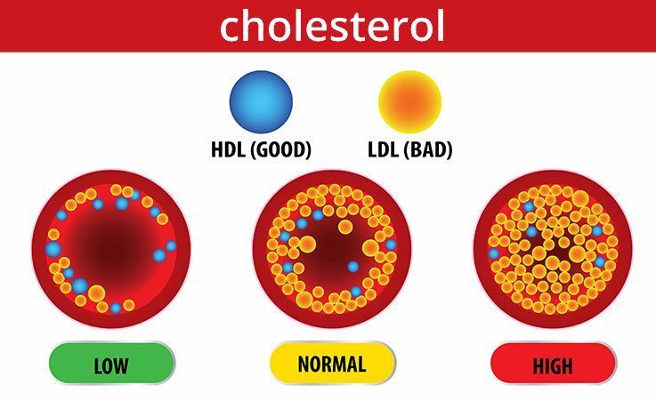 Hiperlipidemia ; Kolesterol Tinggi, Trigliserida Tinggi