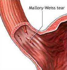 Sindroma Mallory-Weiss