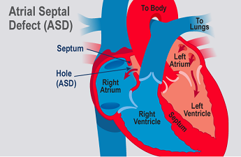 Defek Septum Atrium (ASD, Atrial Septal Defect)