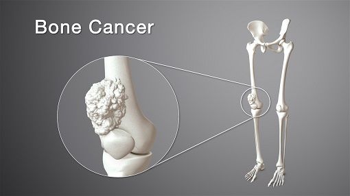 Kanker Tulang Primer
