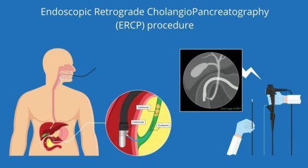 Cholangiopancreatography Retrograde Endoscopic