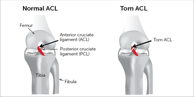 Cedera Ligamen ACL Lutut
