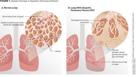 Fibrosis Pulmoner Idiopatik