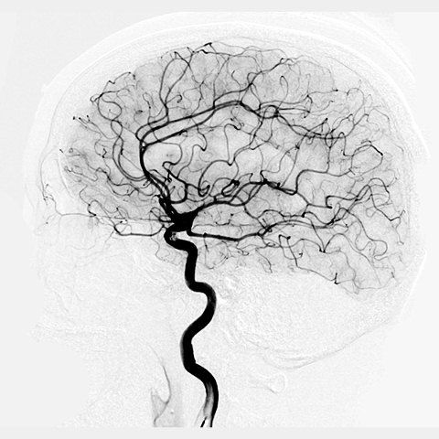 Angiografi Pembuluh Darah Otak (Cerebral Angiography)