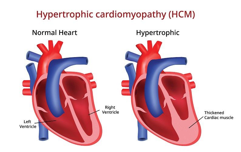 Kardiomiopati Hipertrofi