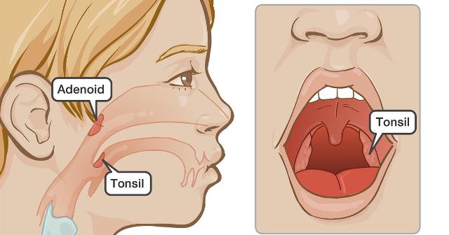 Pembesaran Tonsil (Amandel) dan Adenoid