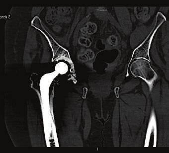 CT Scan Tulang