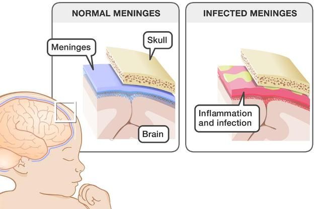 Meningitis pada Bayi; Radang Selaput Otak