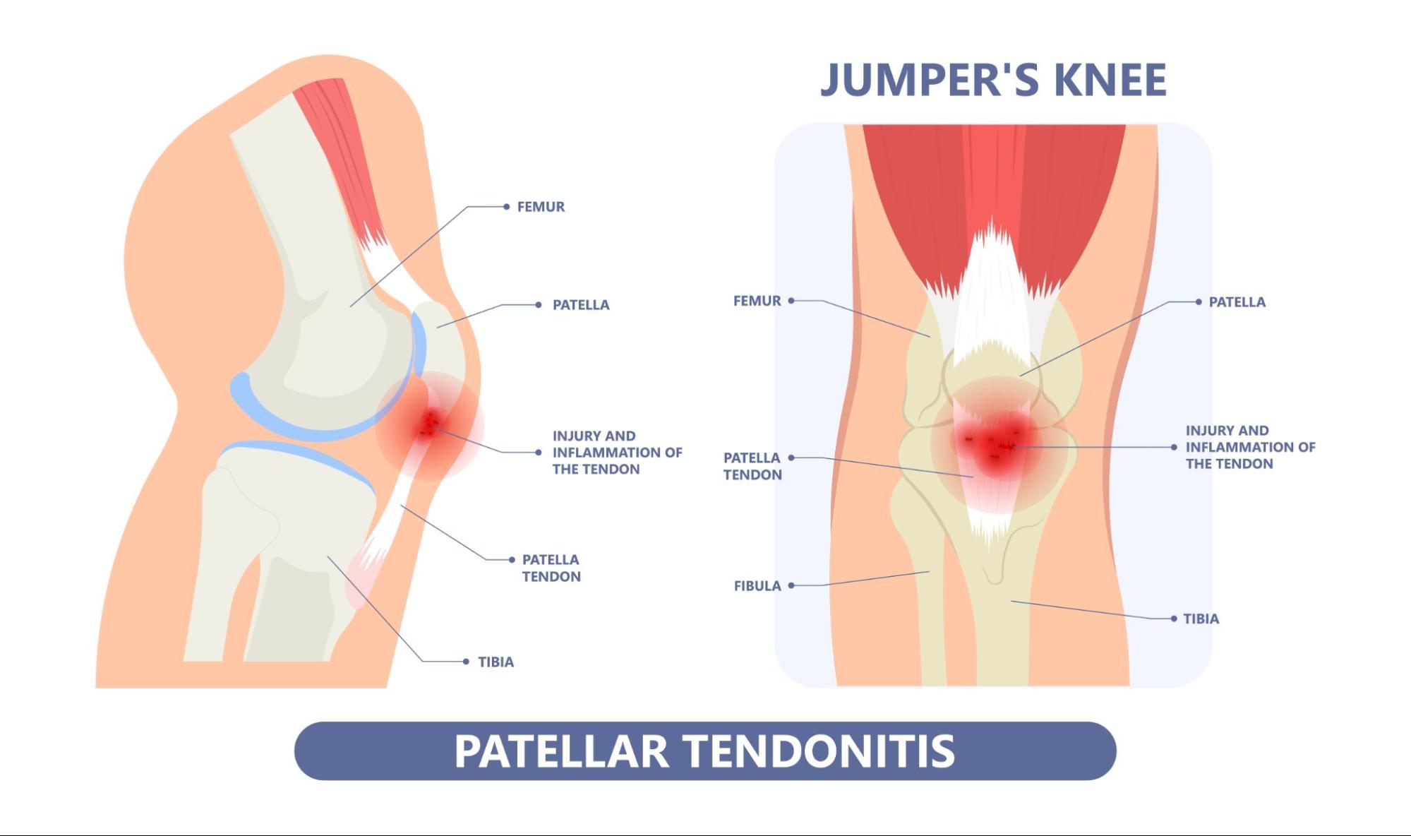 Jumper's Knee (Patellar Tendonitis)