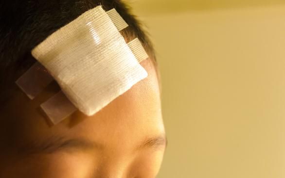 Cedera Kepala pada Anak