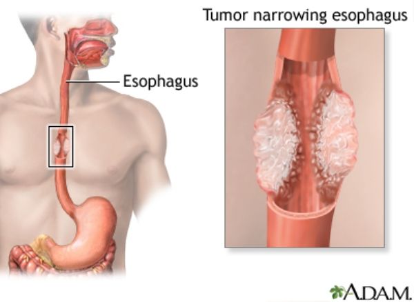 Kanker Esofagus