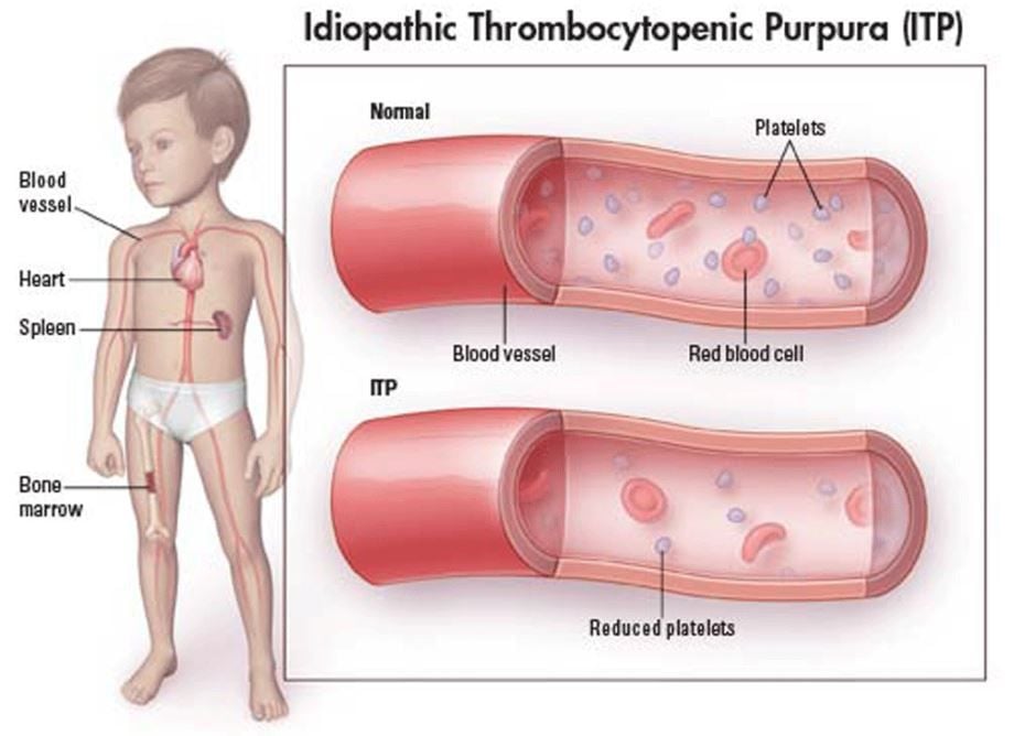 ITP (Idiopathic Thrombocytopenic Purpura)