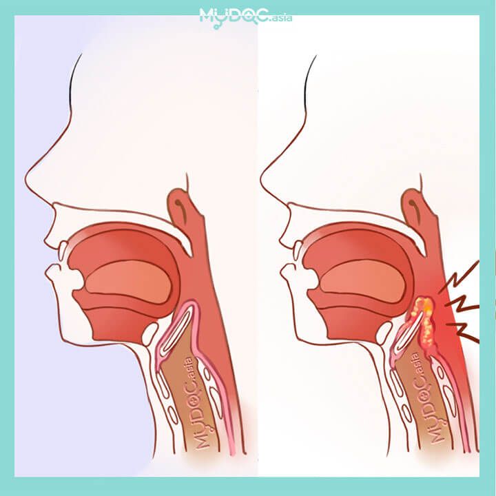 Epiglotitis (Radang Epiglotis)