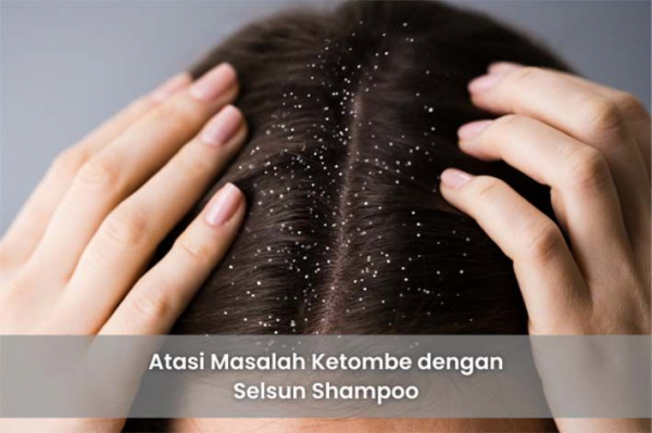 Atasi Masalah Ketombe dengan Selsun Shampoo