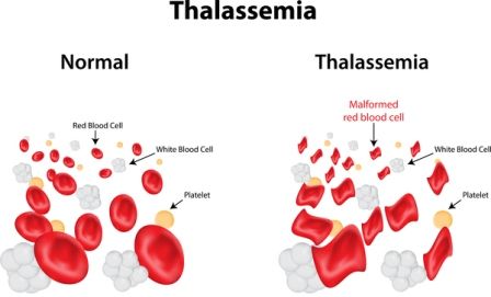 Penyakit Kelainan Darah, Thalassemia
