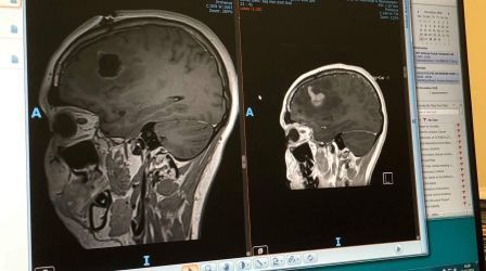Sakit Kepala Tidak Sembuh-sembuh, Apakah Gejala Kanker Otak?