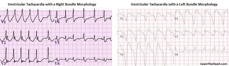 EKG takikardia ventrikel