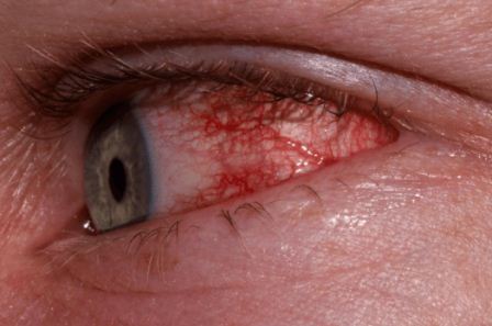 konjungtivitis alergika mata merah