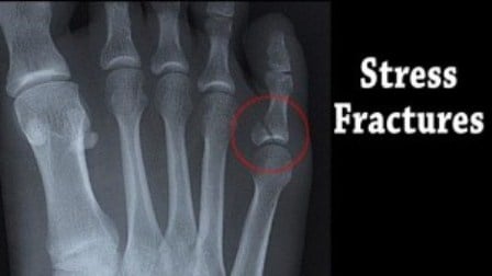 Gambaran Rontgen Patah Tulang karena Tekanan (Stress Fracture)