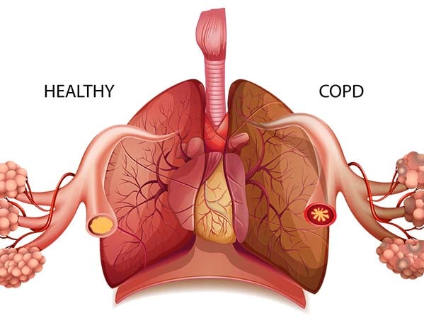 Informasi tentang COPD