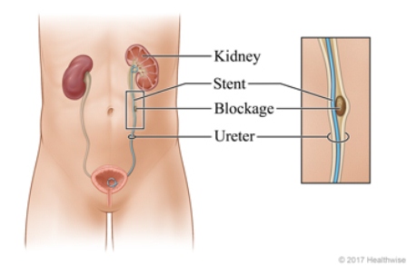 stent ureter
