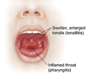 tonsilofaringitis