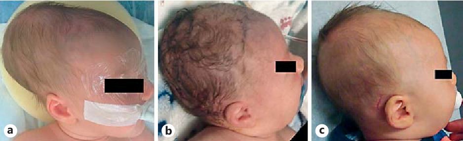 sefalhematoma cedera lahir kepala bayi bengkak
