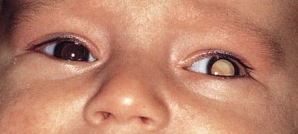 gejala kanker mata retinoblastoma