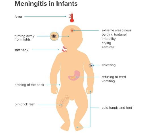 gejala meningitis pada bayi