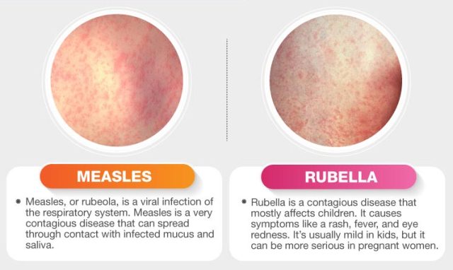 penyakit campak dan rubella
