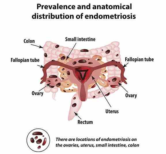 lokasi endometriosis