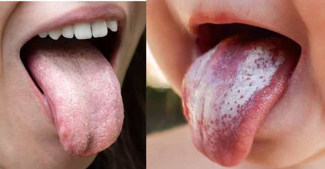 kandidiasis oral atau infeksi jamur di mulut