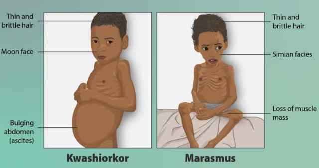 malnutrisi marasmus kwashiorkor