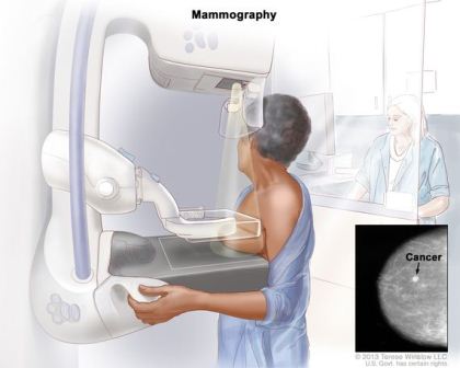 pemeriksaan mammografi