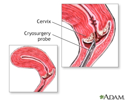 cryosurgery serviks