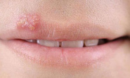 herpes di bibir