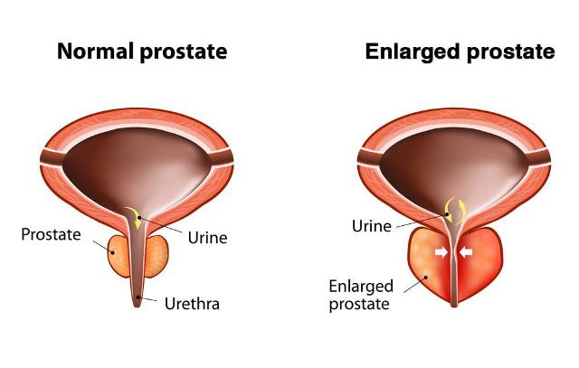penyakit prostat