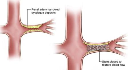 stent sumbatan arteri renalis