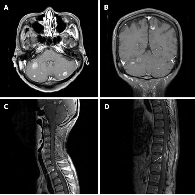 MRI otak dan tulang belakang