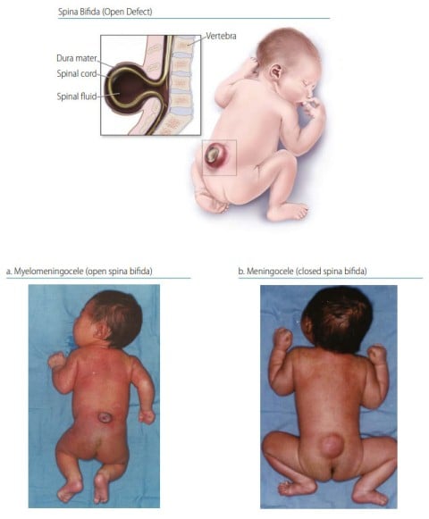 spina bifida meningokel