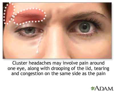 sakit kepala cluster