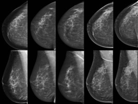 hasil pemeriksaan mammografi