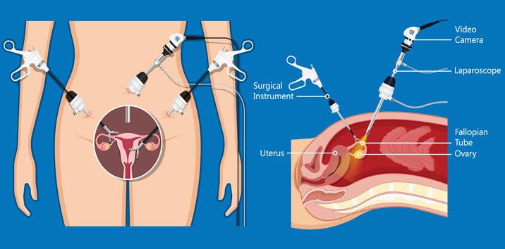 laparoskopi kista ovarium