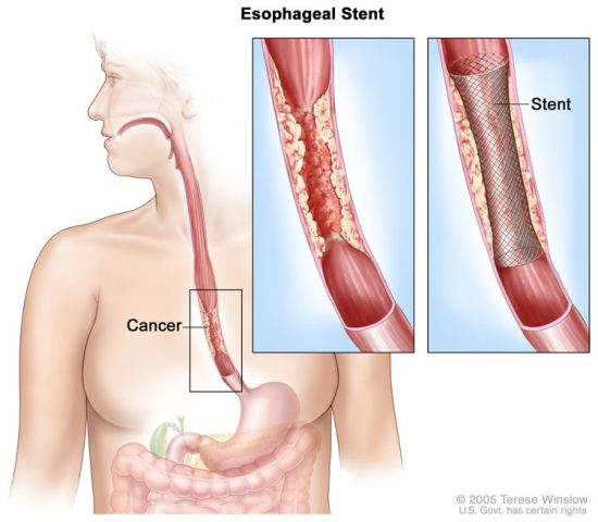 stent esofagus