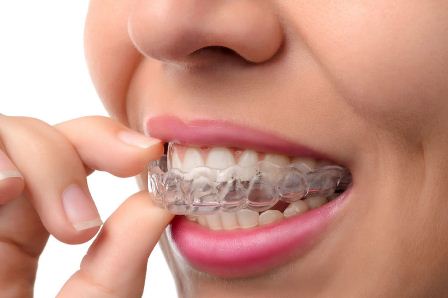mouthguard pelindung gigi sensitif